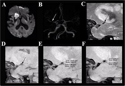 Frontiers | A High-Resolution MRI Study of Relationship between Remodeling Patterns and Ischemic ...