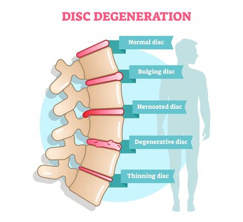 The 3 Stages Of Degenerative Disc Disease | New Jersey | Comprehensive Spine Care