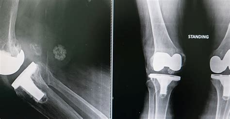 Understanding Different Types of Knee Replacement Surgery