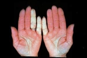 Raynaud's Phenomenon Symptoms & Natural Treatment