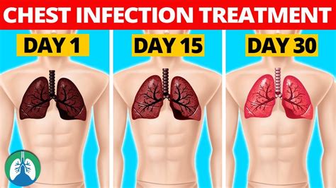 7 Natural Chest Infection Treatments (Home Remedies) - YouTube