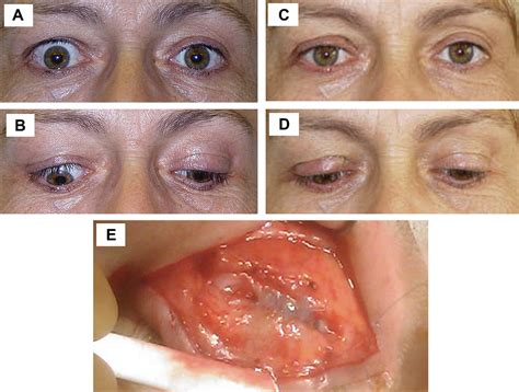 Surgical treatment of Graves' ophthalmopathy. | Semantic Scholar