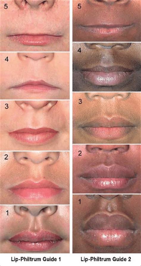 Philtrum of lip, causes of smooth philtrum, long or short philtrum