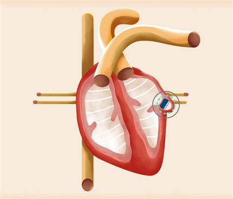 Watchman Procedure for Atrial Fibrillation - FixAFib