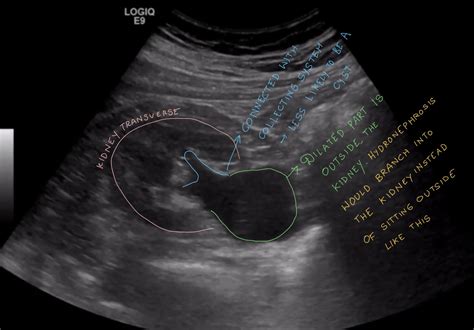 Extrarenal Pelvis