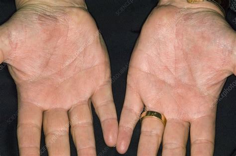 Psoriasis on the palm of the hands - Stock Image - C008/5734 - Science Photo Library