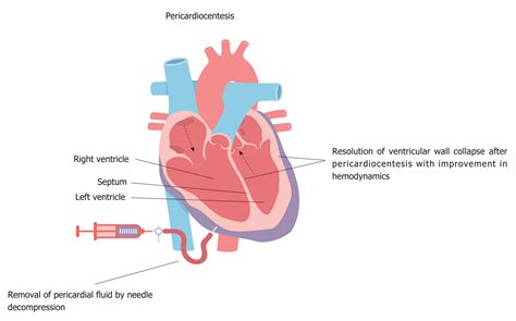 Pericardial decompression syndrome: A comprehensive review