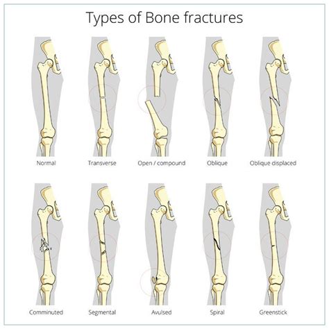 Different Types Of Fractures