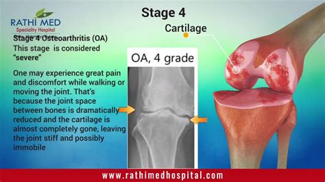 Osteoarthritis Stages Knee