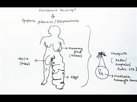 Wuchereria bancrofti: characteristics, transmission, symptoms - science - 2024