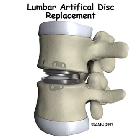 Artificial Disc Replacement Surgery - An Alternative to Lumbar Fusion