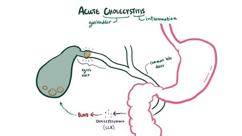 Acute cholecystitis: Video, Anatomy & Definition | Osmosis