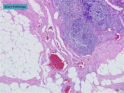 Qiao's Pathology: Angiodysplasia of the Colon | Microscopic … | Flickr