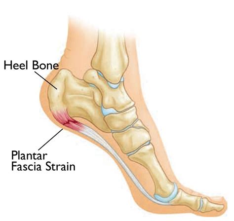 Endoscopic and Gastrocnemius Recession Surgery - Plantar People