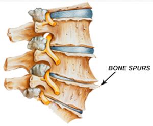 Cervical Bone Spurs - Cervical Osteophytes - Neck Pain