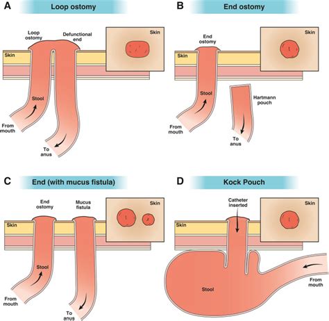 AGA Clinical Practice Update on Management of Ostomies: Commentary ...