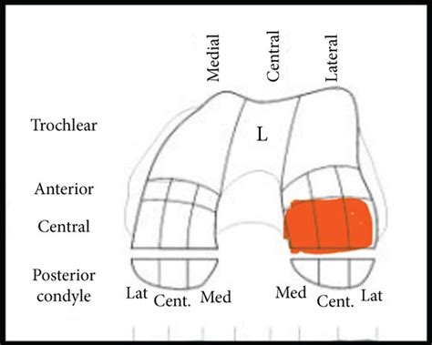 Cartilage mapping showing location of defect: (a) left lateral condyle... | Download Scientific ...