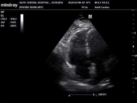 mcconnell sign Mcconnell pulmonary embolism bmj casereports - IMAGE FLUENT