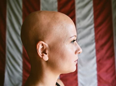 Alopecia Universalis — Living For Everything