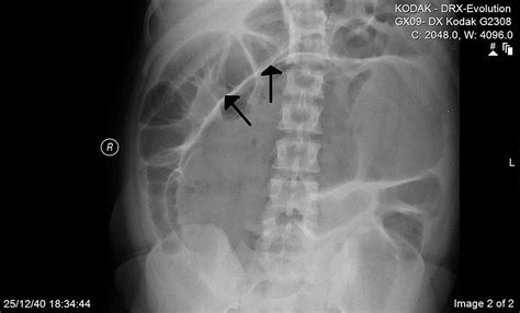 Cureus | Cecal Volvulus Post Cesarean Section: A Case Report