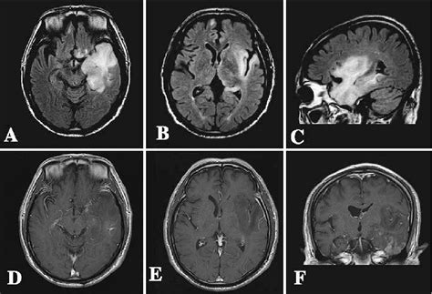 Figure 2 from A case of gliomatosis cerebri mimicking limbic ...