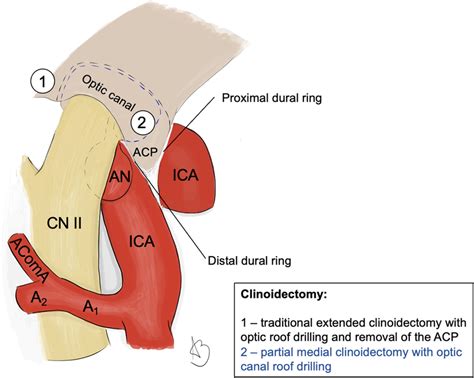 Comparison between the extents of clinoidectomy for the clipping of OA... | Download Scientific ...