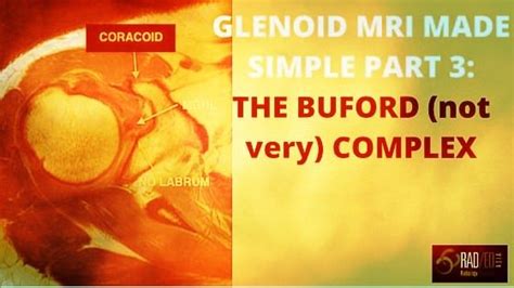 GLENOID LABRUM MRI SIMPLIFIED 3: Buford Complex (not complex at all) - Radedasia