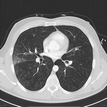 Secondary pulmonary lobules outlined by aspiration | Radiology Case ...