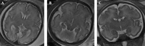 T2-weighted magnetic resonance images (MRI) show the brain cortical... | Download Scientific Diagram