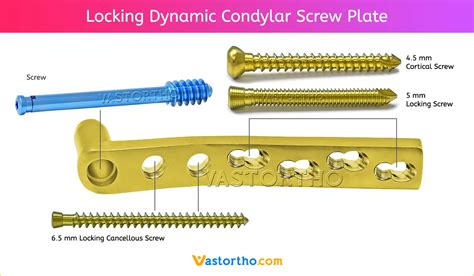 Locking Dynamic Condylar Screw Plate uses & sizes • Vast Ortho