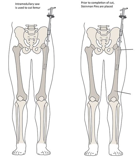 Femoral Osteotomy: An Overview