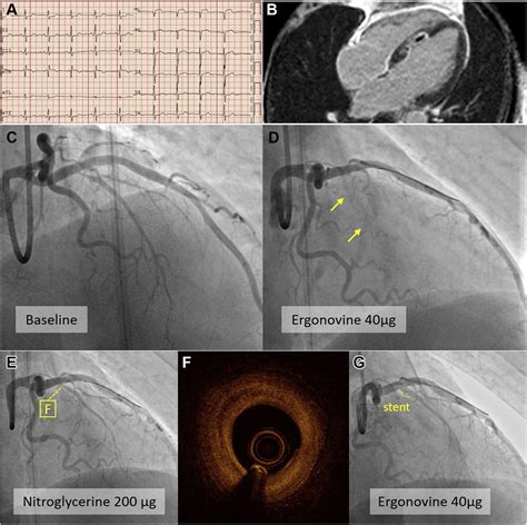 Stent-Based Treatment of Refractory Coronary Vasospasm | JACC ...