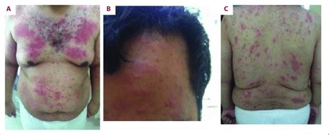 Case 1: Widespread rash 3 weeks after surgery. Erythematous ...