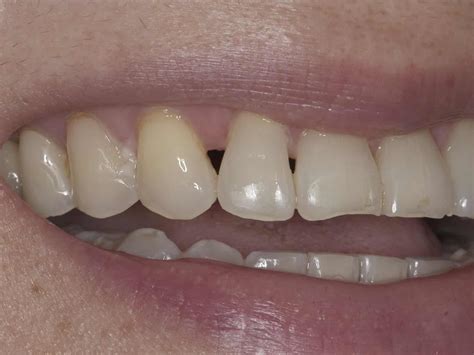 Fixing Black Triangles Between Teeth With Bioclear | Craig V. Smith DDS FAGD