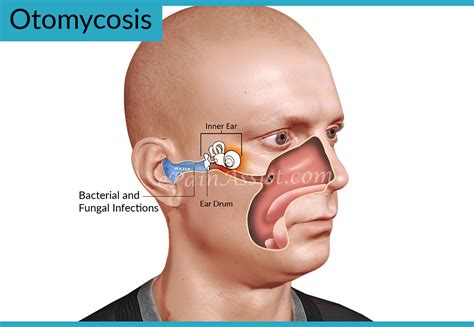 Otomycosis or Ear Fungus: Treatment, Home Remedies, Causes, Signs