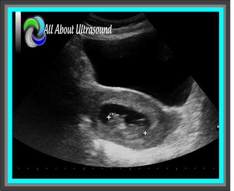 5 Best Practice Tips to OB GYN Ultrasound