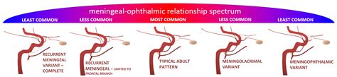 Index of /wp-content/uploads/Technique/cSDH-MMA-embolization