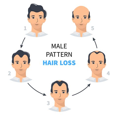 Hair loss stages, androgenetic alopecia male pattern. Steps of baldness vector infographic in a ...