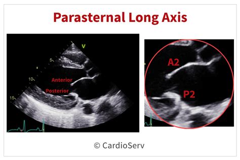 Finally... Mitral Valve Orientation Explained! Cardioserv