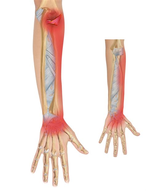 Anatomy of the Lateral Elbow Part 2