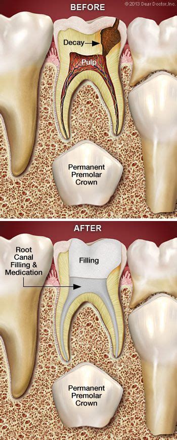 baby root canal and crown - Important Project History Fonction