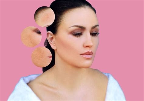 The 6 Best Treatments for Hyperpigmentation