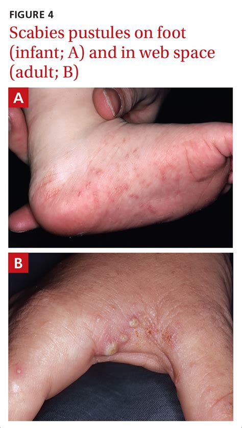 Scabies Linear Burrows Pictures - Asesores