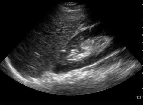 FAST Exam: Normal Morrison's Pouch - JETem