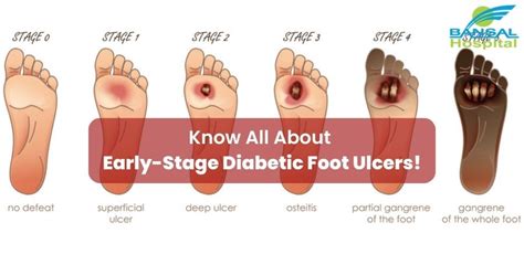 Know All About Early-Stage Diabetic Foot Ulcers!