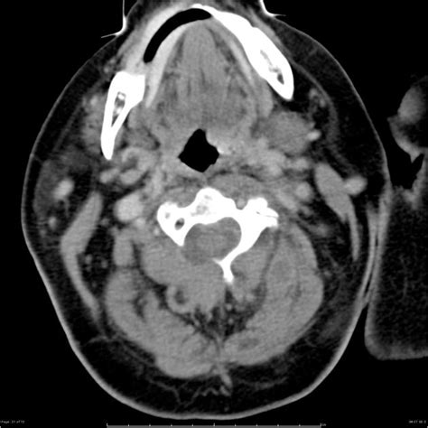 Epidural abscess CT - wikidoc