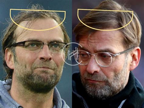 Jurgen Klopp Hair Transplant - Hair Loss & Technical Analysis