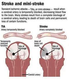 eliciting Homans' Sign #nursing | Homans sign, Nurse, Nursing information