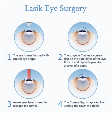 regulär Behinderung Meer laser eye surgery how many times can you get ...