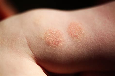 Eczema in Kids: What Parents Can Do to Calm the Itch | For Parents | US News